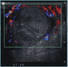 testicular late torsion extratestbloodflow