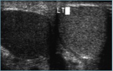 testicular torsion early