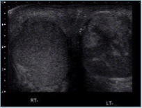 testicular torsion late