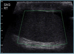 testiculartorsionnoflow