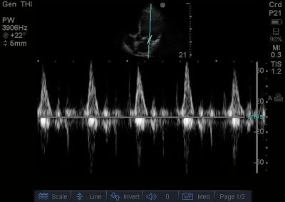 32yo M Mitral Doppler