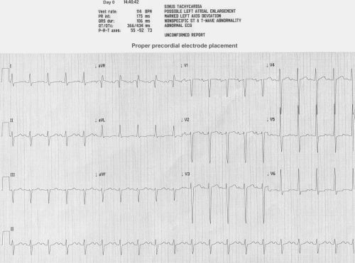 32yo M - SOB on Exertion x 3 wks_ECG