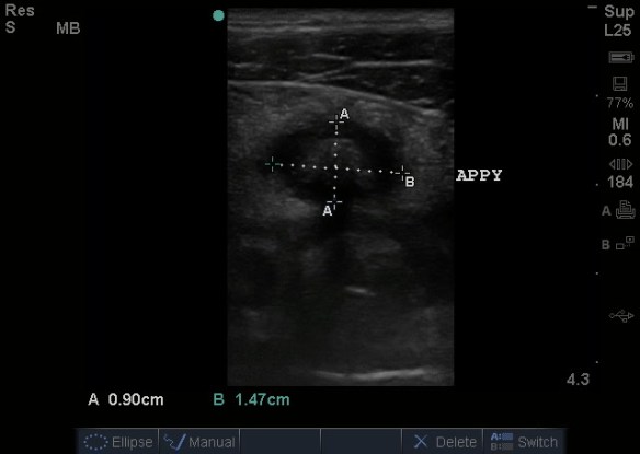 APPENDICITIS WITH MEASUREMENTS_crop