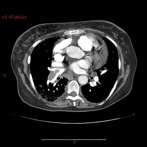 Avila_Clot in pulmonary artery CT