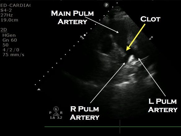 Pulm clot labeled