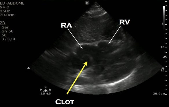 RA clot labeled