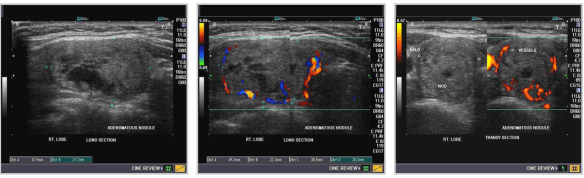 thyroid_adenomatous nodules