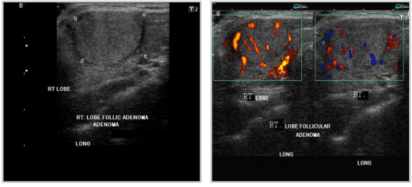 thyroid_follicular adenoma