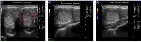 thyroid_follicular adenomas