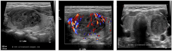 thyroid_papillary carcinoma
